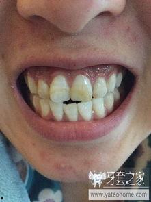 成人门牙歪贴片处理视频,跟随视频轻松掌握矫正技巧